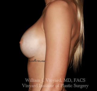 Breast Augmentation Before & After Gallery - Patient 416669 - Image 6