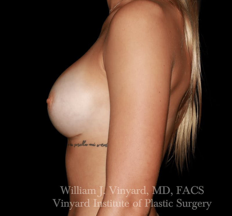 Breast Augmentation Before & After Gallery - Patient 416669 - Image 6
