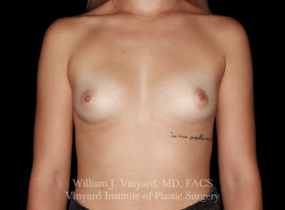 Breast Augmentation Before & After Gallery - Patient 416669 - Image 1