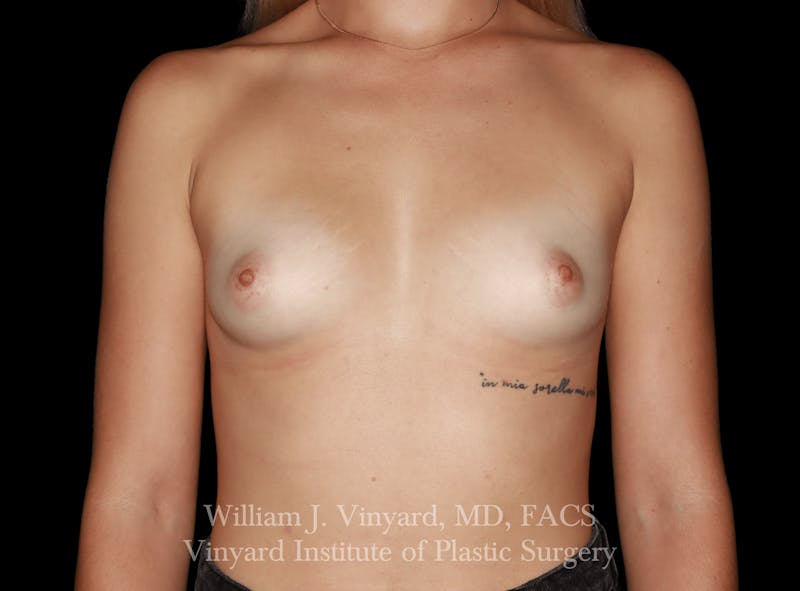 Breast Augmentation Before & After Gallery - Patient 416669 - Image 1