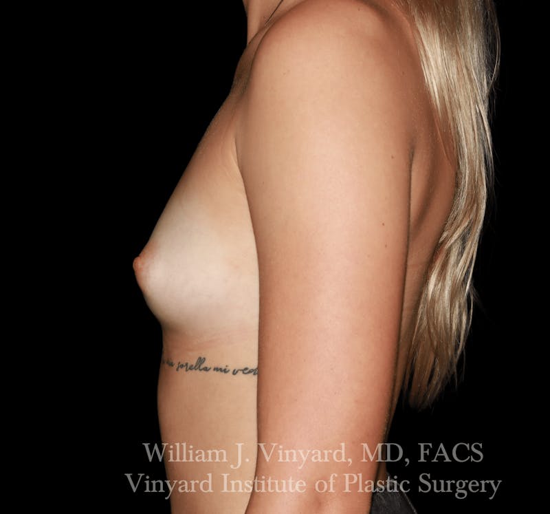 Breast Augmentation Before & After Gallery - Patient 416669 - Image 5