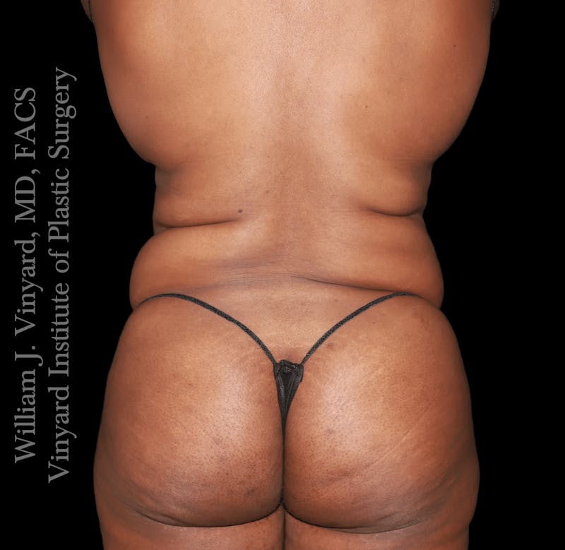 Tummy Tuck Before & After Gallery - Patient 423835 - Image 7