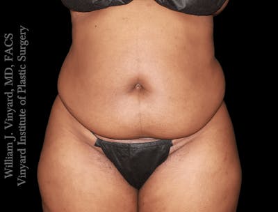 Tummy Tuck Before & After Gallery - Patient 423835 - Image 1