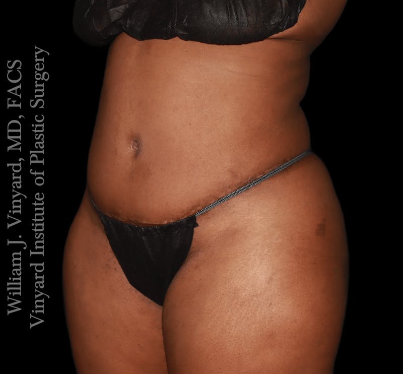 Tummy Tuck Before & After Gallery - Patient 423835 - Image 4