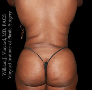 Tummy Tuck Before & After Gallery - Patient 423835 - Image 8