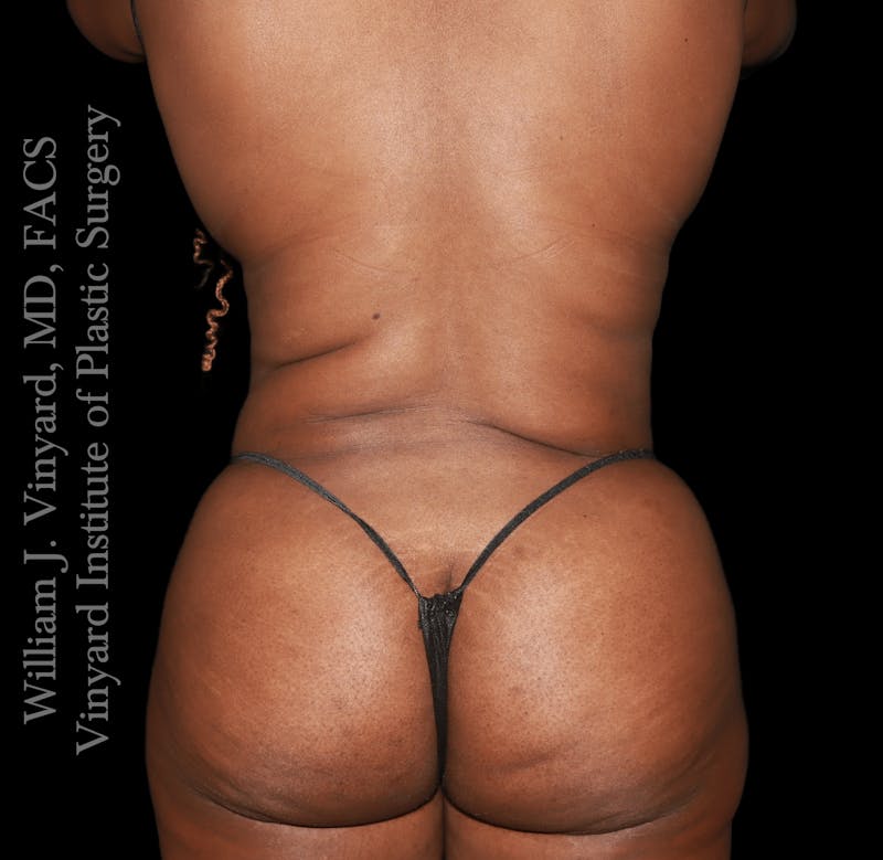 Tummy Tuck Before & After Gallery - Patient 423835 - Image 8