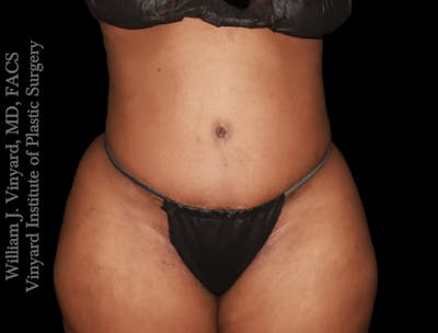 Tummy Tuck Before & After Gallery - Patient 423835 - Image 2