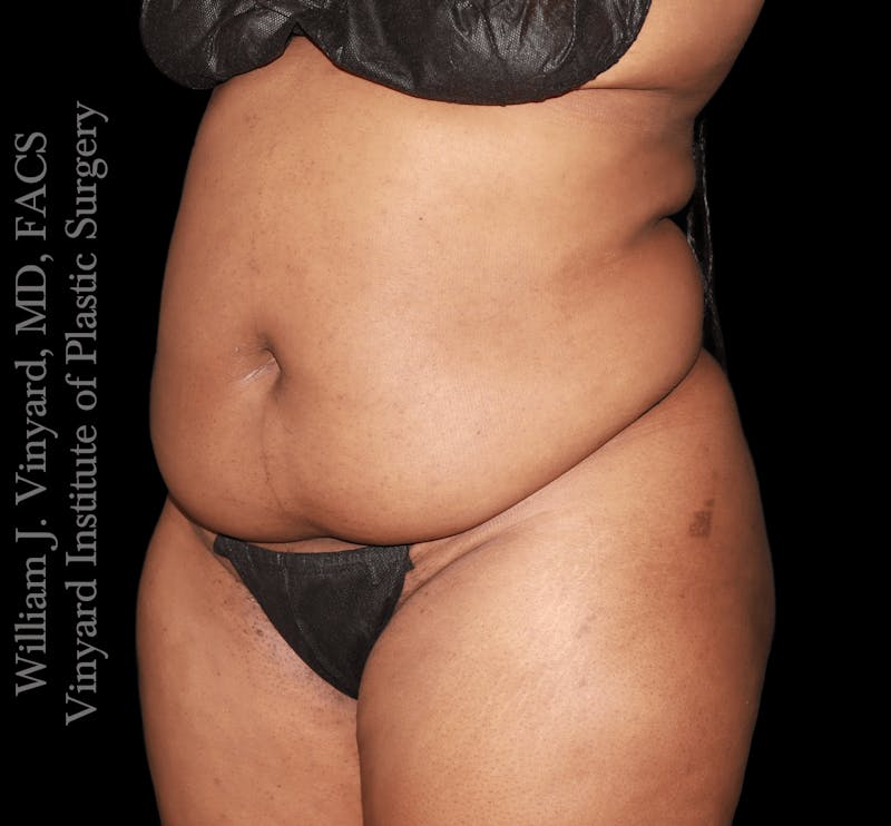 Tummy Tuck Before & After Gallery - Patient 423835 - Image 3