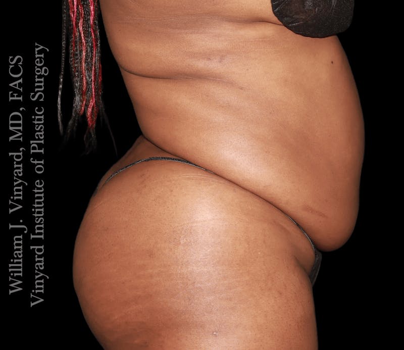 Tummy Tuck Before & After Gallery - Patient 423835 - Image 5