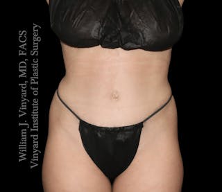 Tummy Tuck Before & After Gallery - Patient 217416 - Image 2