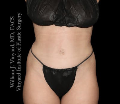 Tummy Tuck Before & After Gallery - Patient 217416 - Image 2