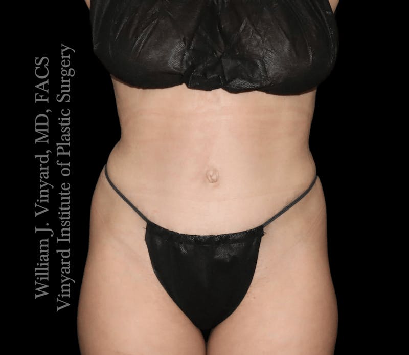 Tummy Tuck Before & After Gallery - Patient 217416 - Image 2