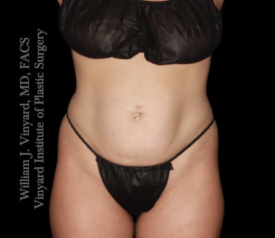 Tummy Tuck Before & After Gallery - Patient 217416 - Image 1