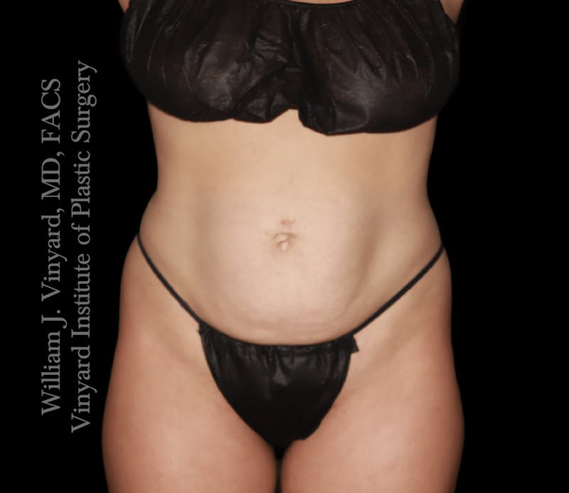 Tummy Tuck Before & After Gallery - Patient 217416 - Image 1