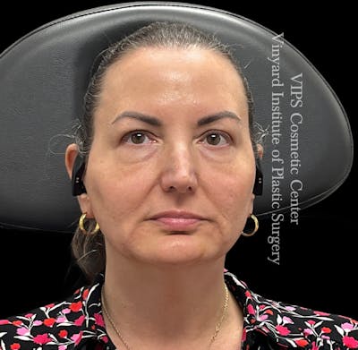 Wrinkle Fillers Before & After Gallery - Patient 644171 - Image 1