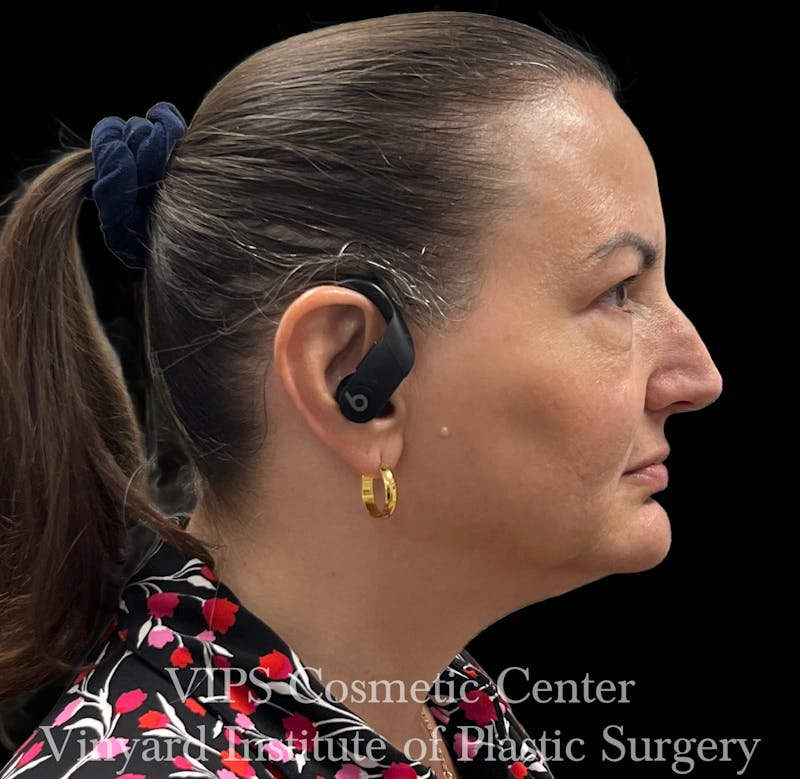 Wrinkle Fillers Before & After Gallery - Patient 644171 - Image 5