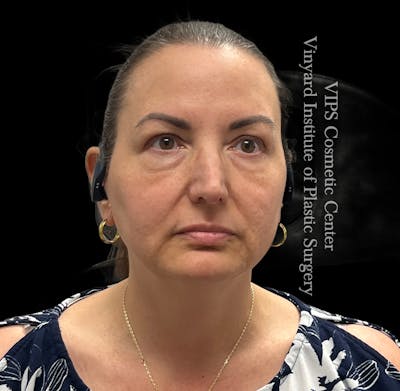 Wrinkle Fillers Before & After Gallery - Patient 644171 - Image 2