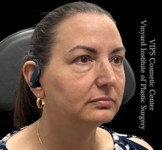 Wrinkle Fillers Before & After Gallery - Patient 644171 - Image 4