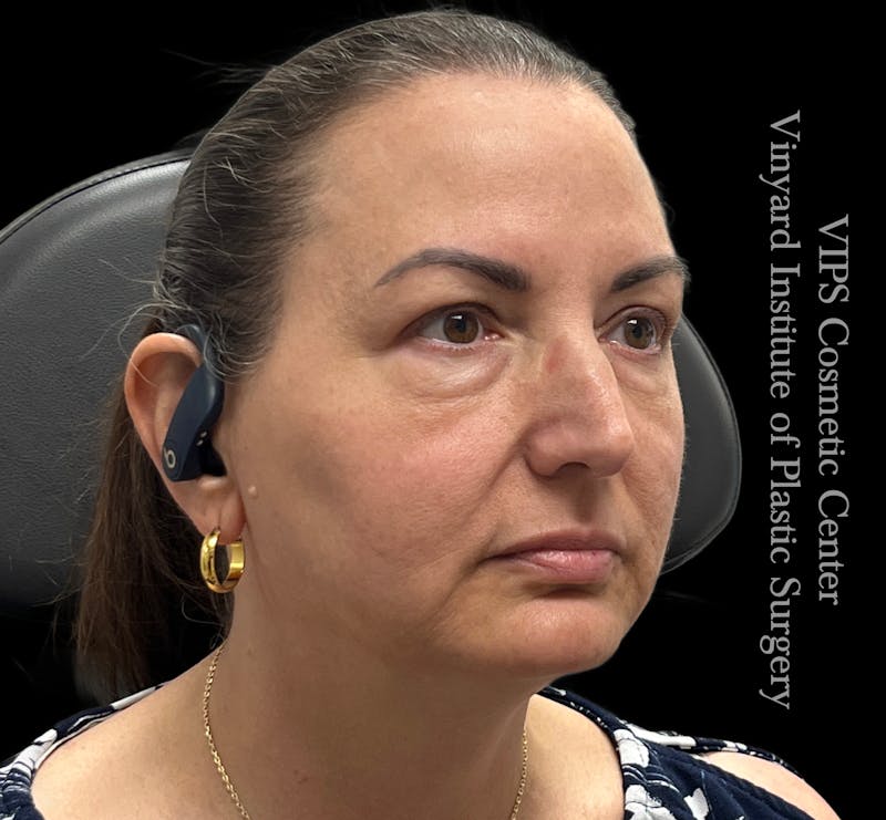 Wrinkle Fillers Before & After Gallery - Patient 644171 - Image 4