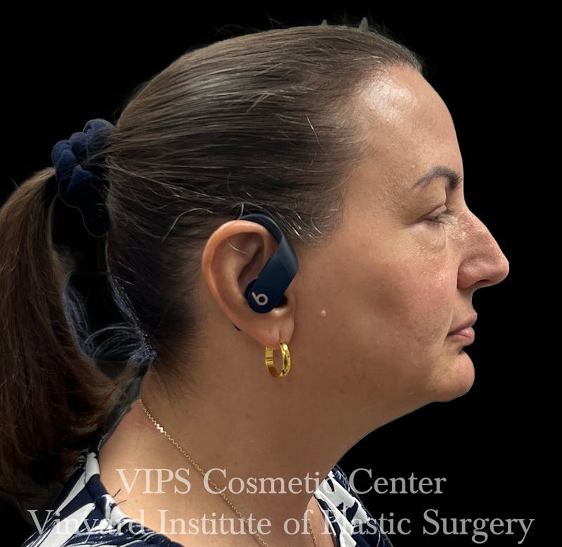 Wrinkle Fillers Before & After Gallery - Patient 644171 - Image 6