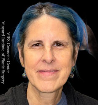 Elluminate Advanced Photofacial w/IPL Before & After Gallery - Patient 296638 - Image 2