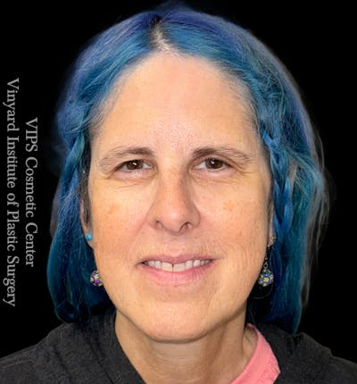 ELLUMINATE WITH IPL Before & After Gallery - Patient 296638 - Image 1