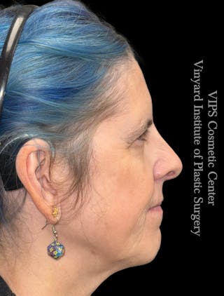 Elluminate Advanced Photofacial w/IPL Before & After Gallery - Patient 296638 - Image 4