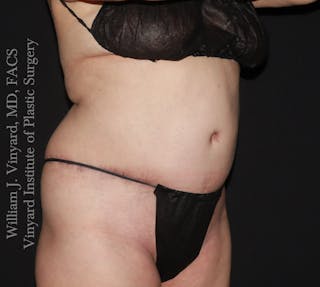 Tummy Tuck Before & After Gallery - Patient 390425 - Image 4