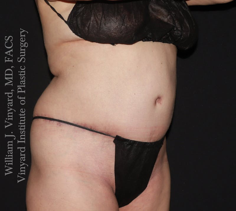 Tummy Tuck Before & After Gallery - Patient 390425 - Image 4