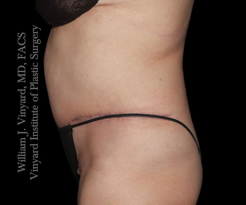Tummy Tuck Before & After Gallery - Patient 390425 - Image 6