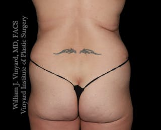 Tummy Tuck Before & After Gallery - Patient 390425 - Image 10