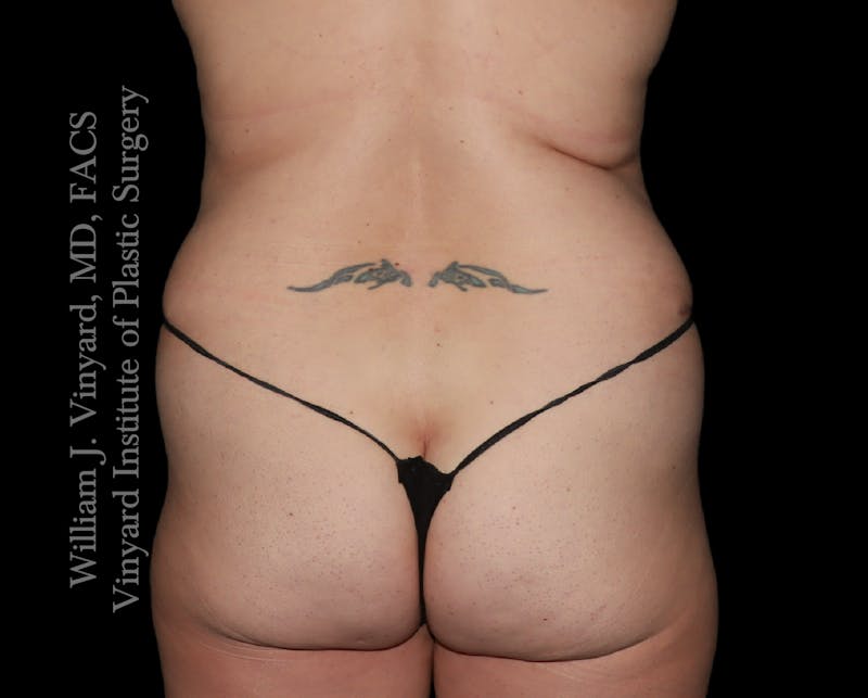 Tummy Tuck Before & After Gallery - Patient 390425 - Image 10