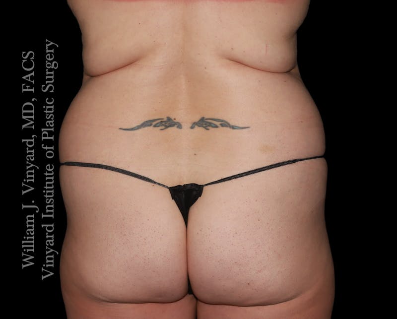 Tummy Tuck Before & After Gallery - Patient 390425 - Image 9