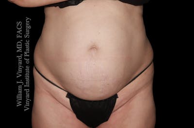 Tummy Tuck Before & After Gallery - Patient 390425 - Image 1