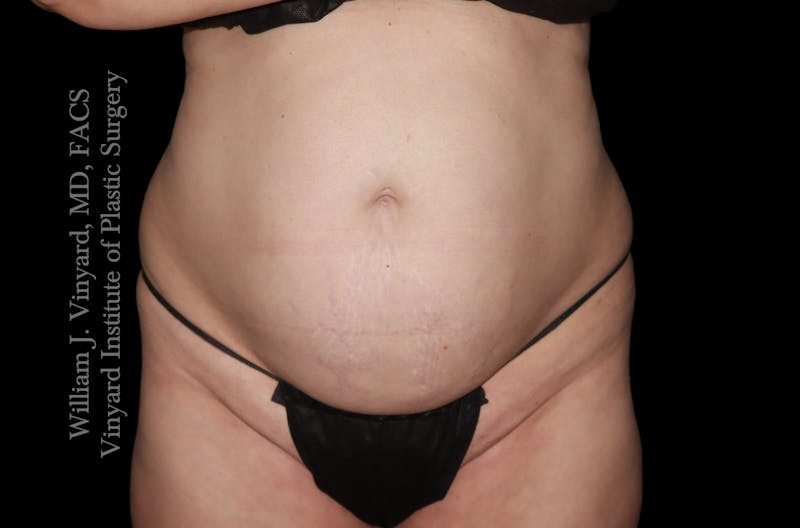 Tummy Tuck Before & After Gallery - Patient 390425 - Image 1