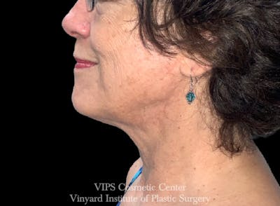 RF Microneedling Morpheus 8 Before & After Gallery - Patient 270004 - Image 2