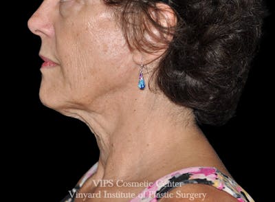 RF Microneedling Morpheus 8 Before & After Gallery - Patient 270004 - Image 1