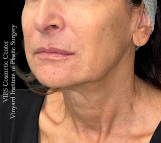 RF Microneedling Morpheus 8 Before & After Gallery - Patient 149245 - Image 4