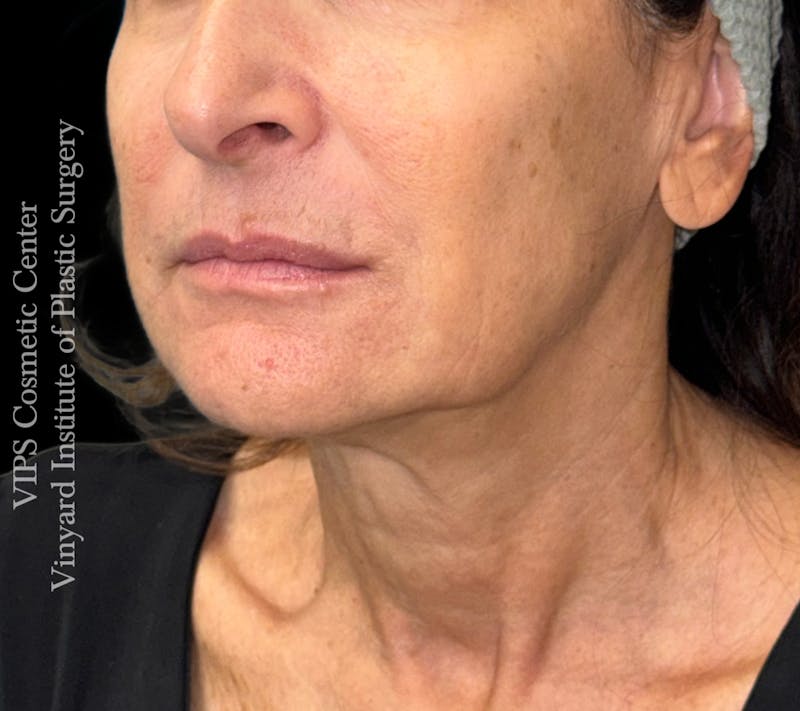 RF Microneedling Morpheus 8 Before & After Gallery - Patient 149245 - Image 4