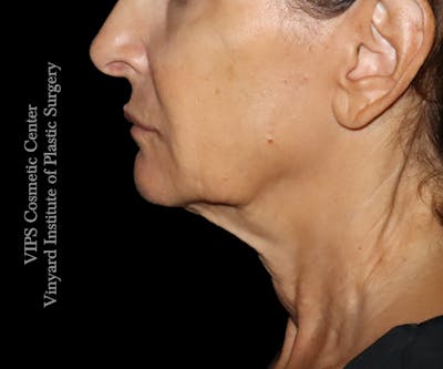 RF Microneedling Morpheus 8 Before & After Gallery - Patient 149245 - Image 1