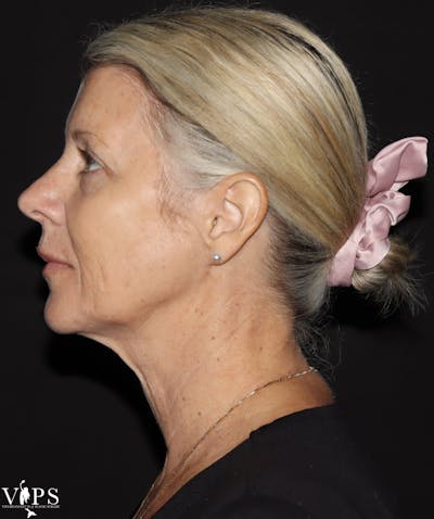 RF Microneedling Morpheus 8 Before & After Gallery - Patient 552573 - Image 2