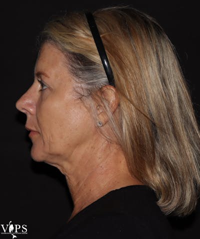 RF Microneedling Morpheus 8 Before & After Gallery - Patient 552573 - Image 1