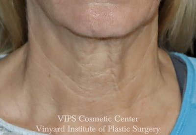 RF Microneedling Morpheus 8 Before & After Gallery - Patient 369149 - Image 2
