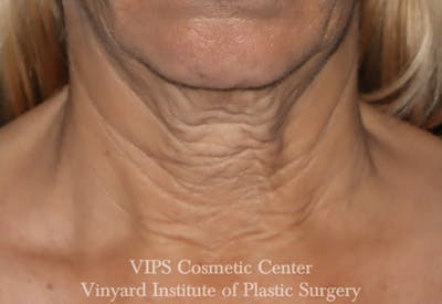 RF Microneedling Morpheus 8 Before & After Gallery - Patient 369149 - Image 1