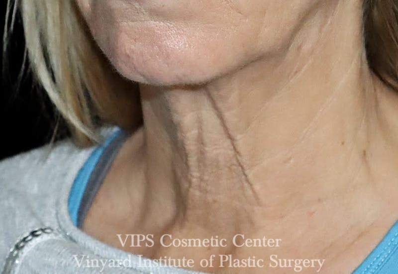 RF Microneedling Morpheus 8 Before & After Gallery - Patient 369149 - Image 6