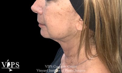 RF Microneedling Morpheus 8 Before & After Gallery - Patient 350527 - Image 2