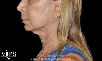 RF Microneedling Morpheus 8 Before & After Gallery - Patient 350527 - Image 1
