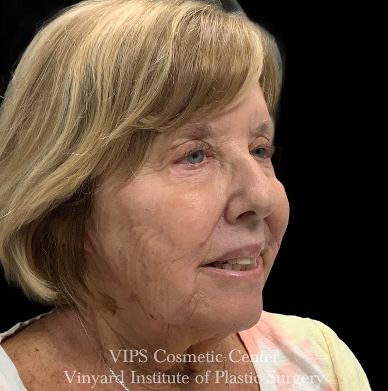 Elluminate Advanced Photofacial w/IPL Before & After Gallery - Patient 318871 - Image 2