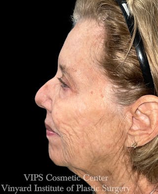 Elluminate Advanced Photofacial w/IPL Before & After Gallery - Patient 318871 - Image 4