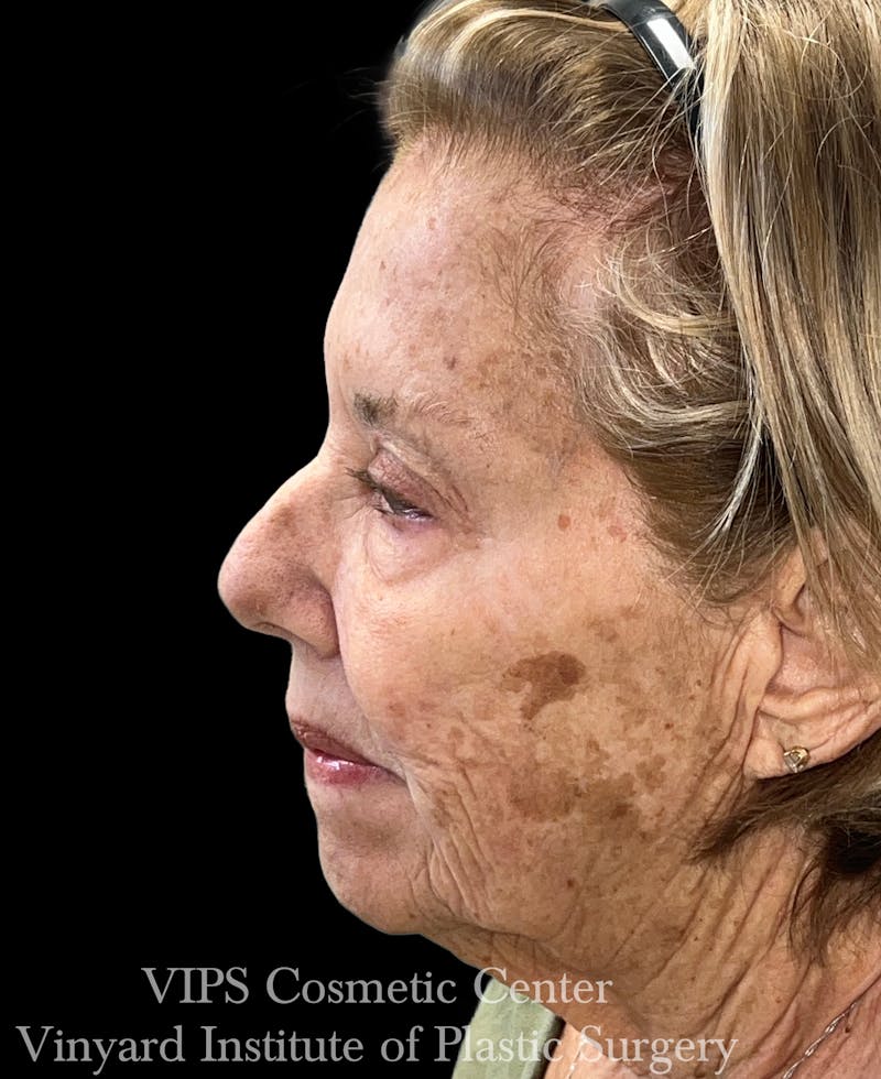 Elluminate Advanced Photofacial w/IPL Before & After Gallery - Patient 318871 - Image 3